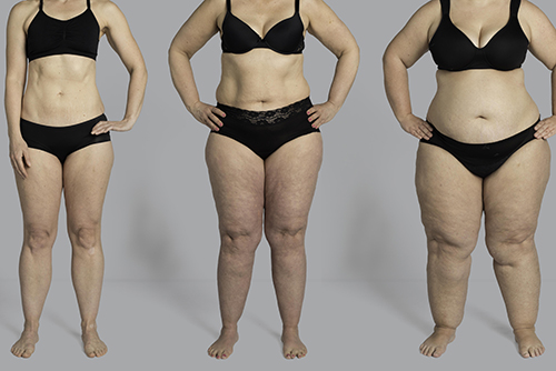 What Is Lipedema?