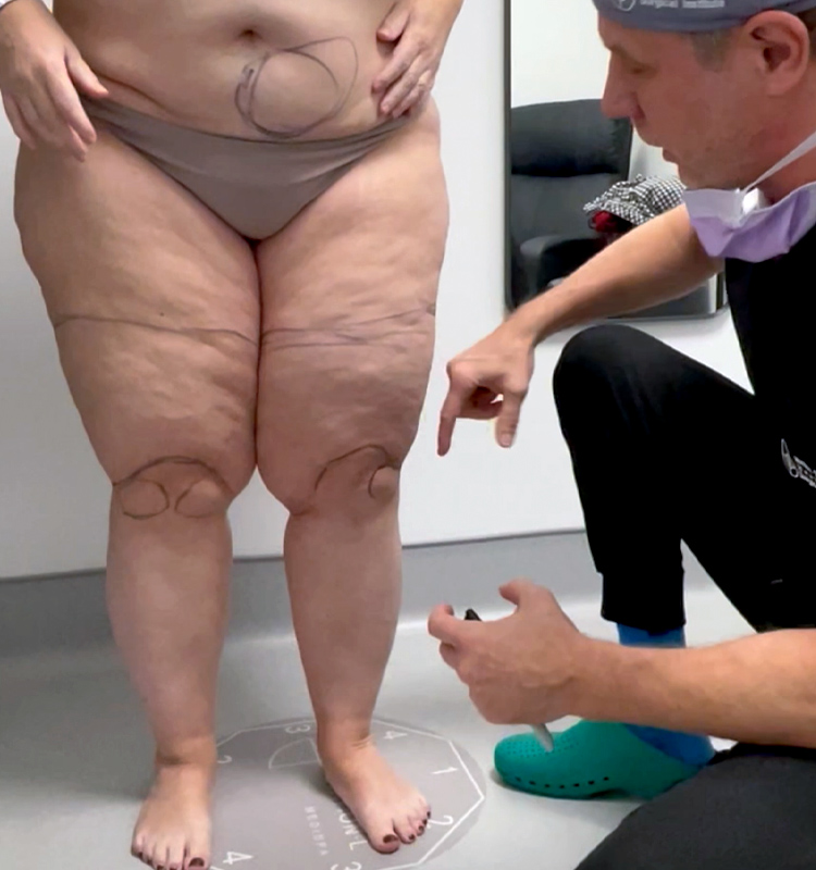 What are Lipedema Symptoms? Montreal - Quebec - Canada