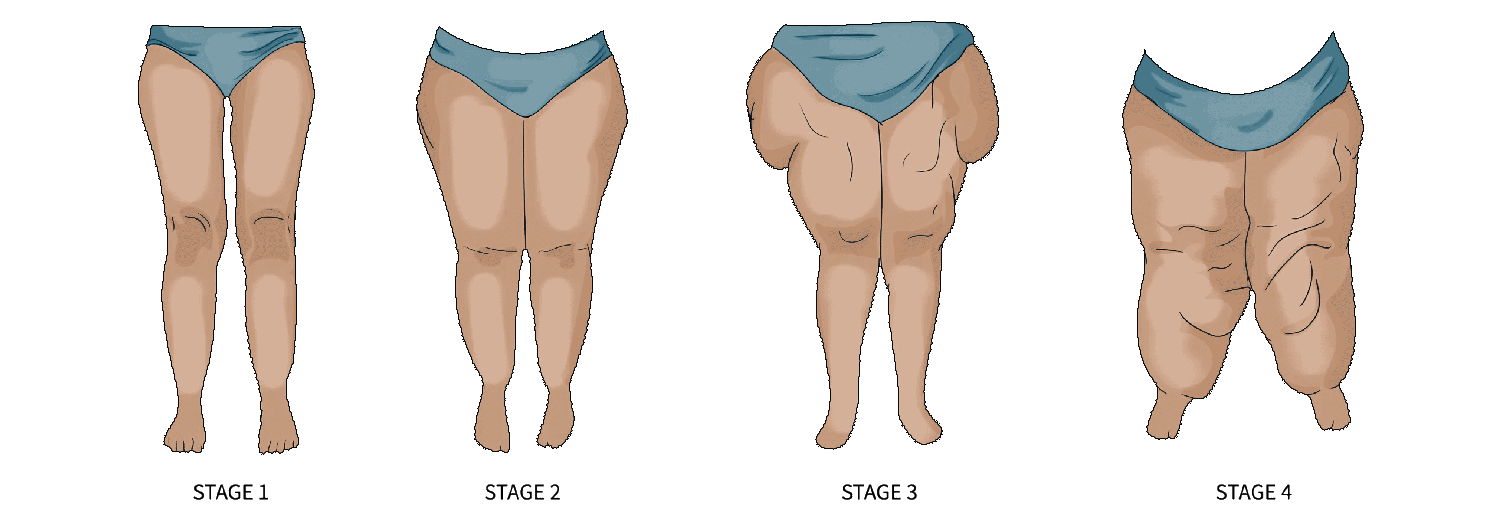Stages of Lipedema 