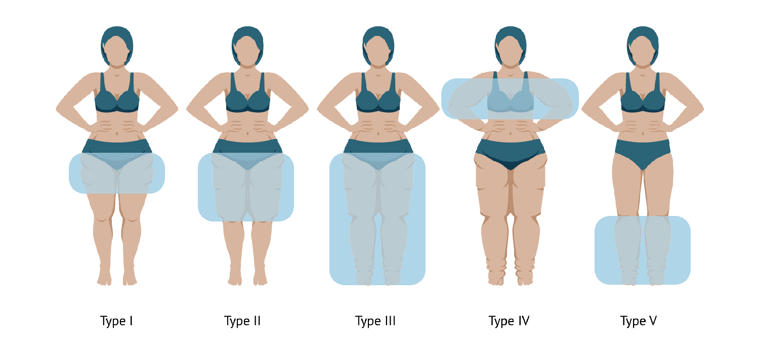 Montreal - Types of Lipedema