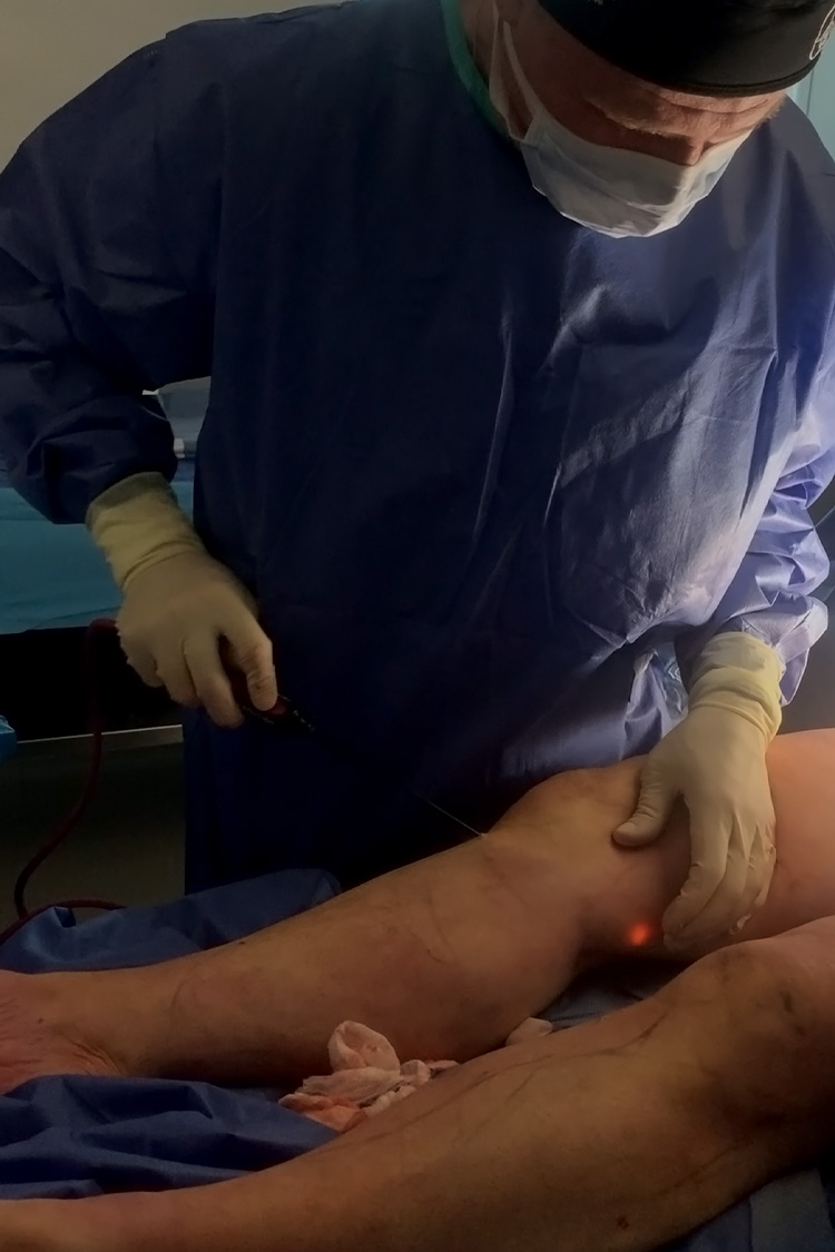 Skin tightening after Lipedema surgery - Lipedema Canada