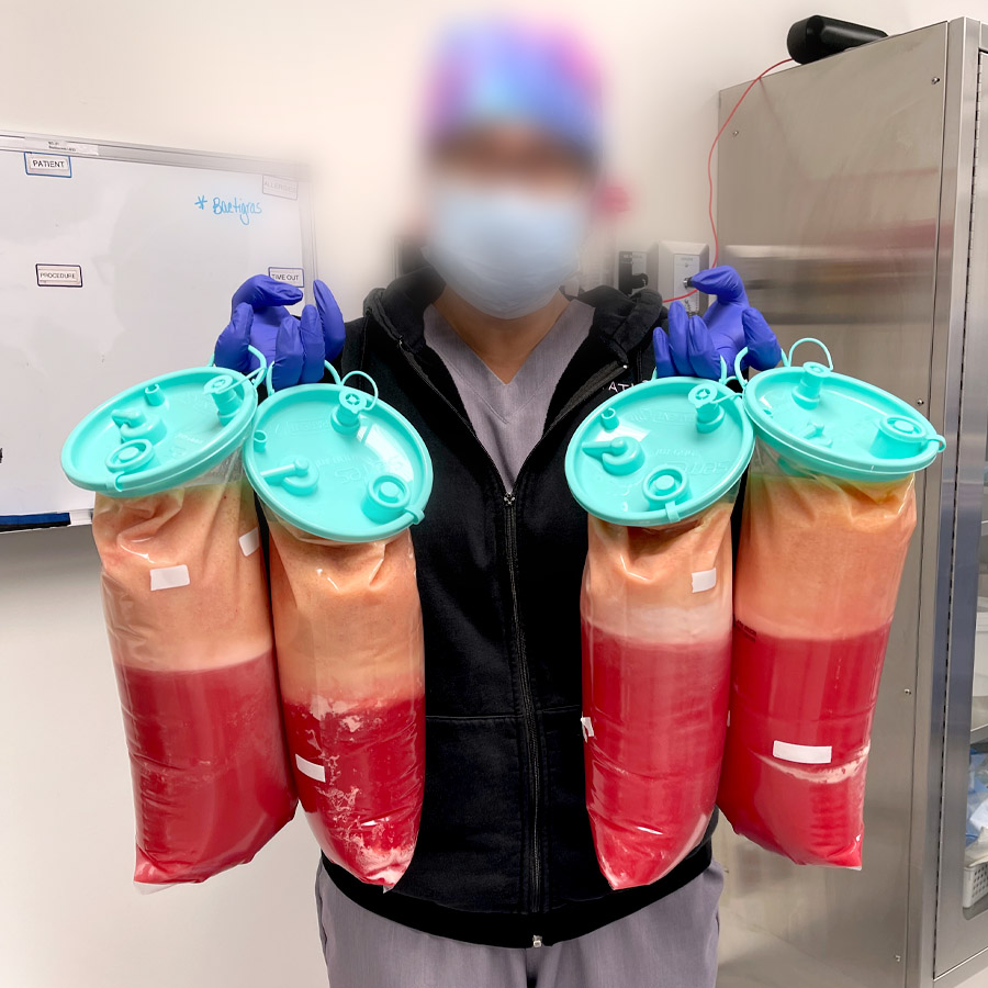 5 liters of FAT / Water Jet-Assisted Liposuction (WAL)