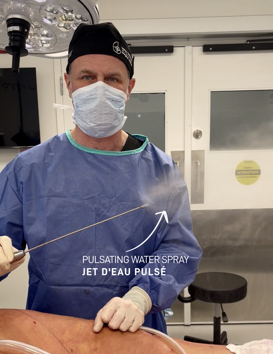 Water Jet-Assisted Liposuction (WAL)