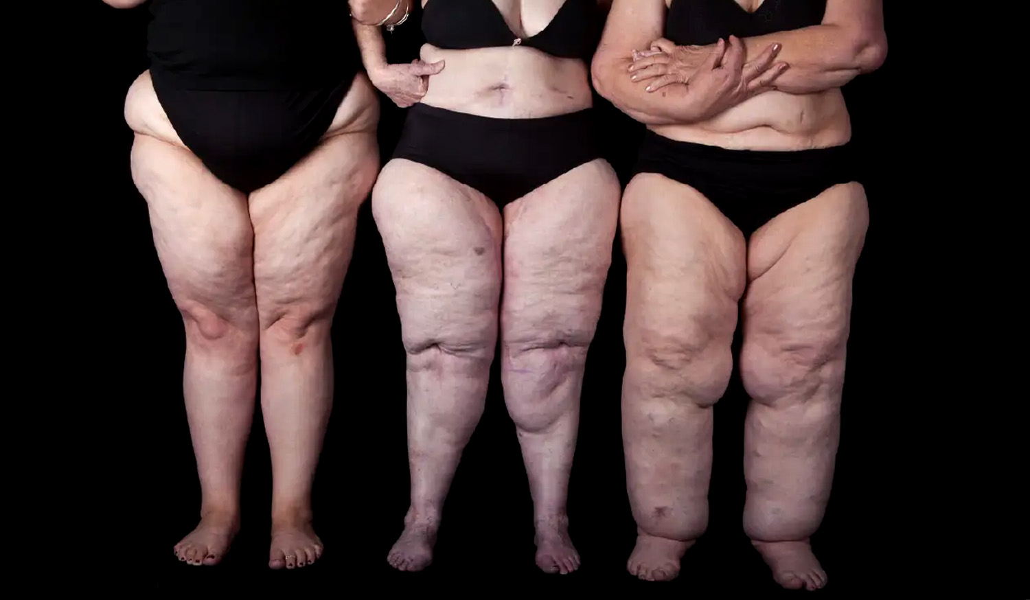 What does Lipedema look like?