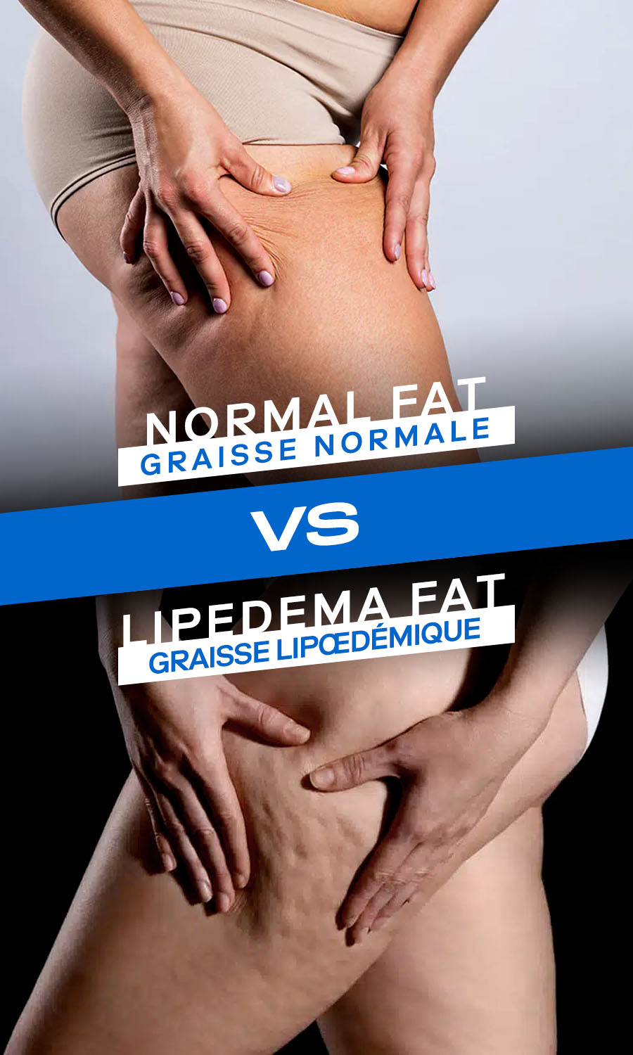 Lipedema Fat vs. Normal Fat