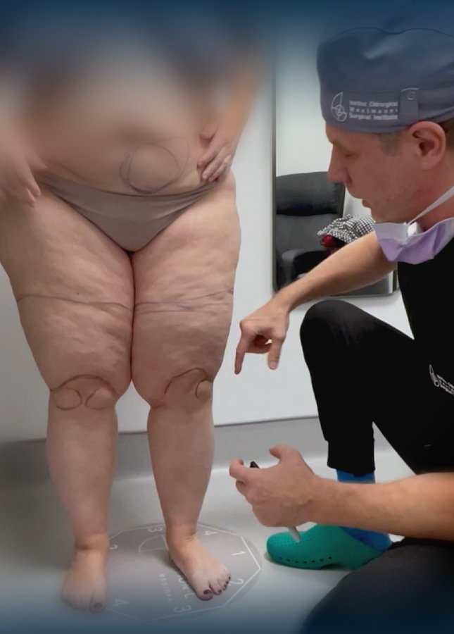 how to recognize lipedema