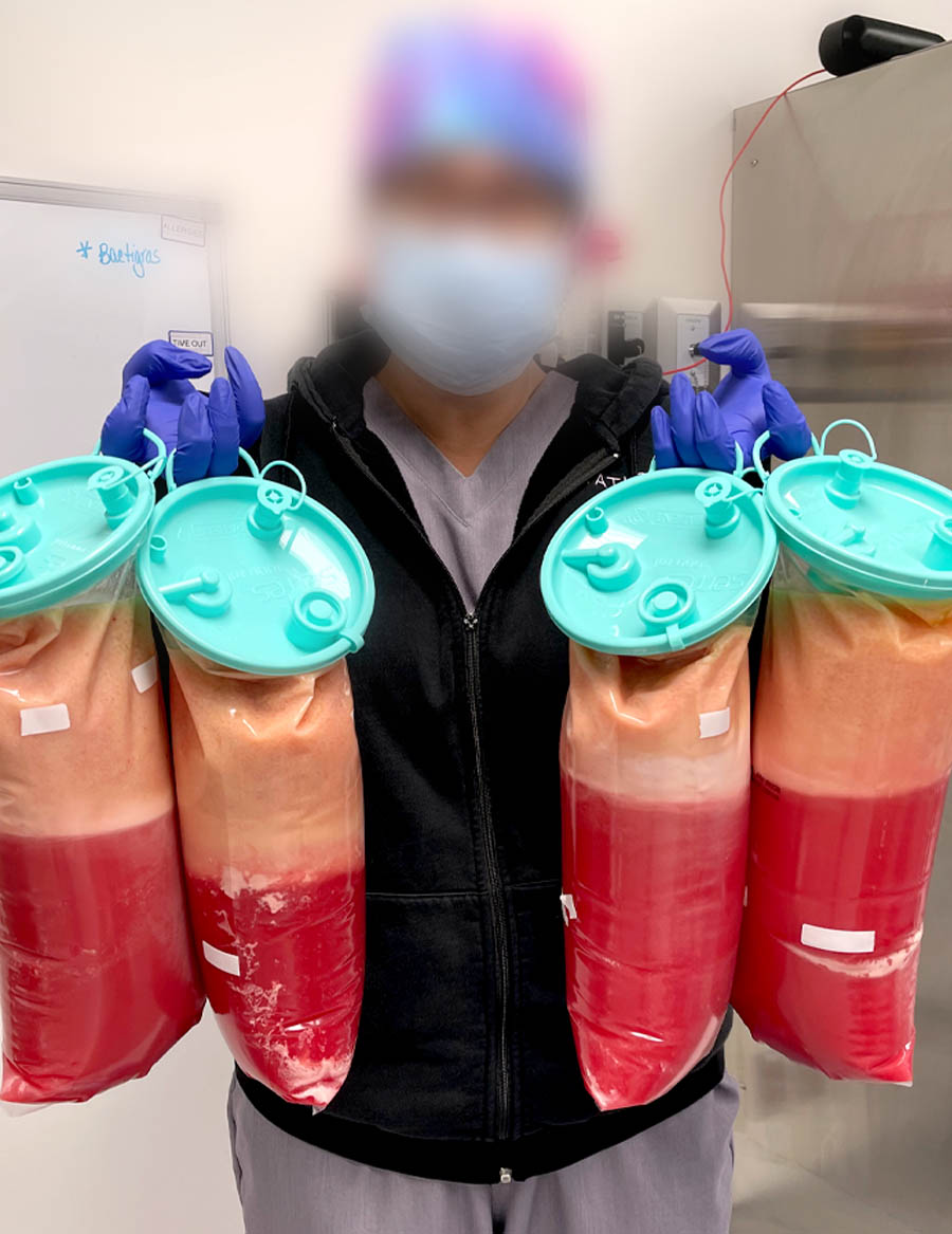 How much fat can you remove in one session with Lipedema Liposuction?