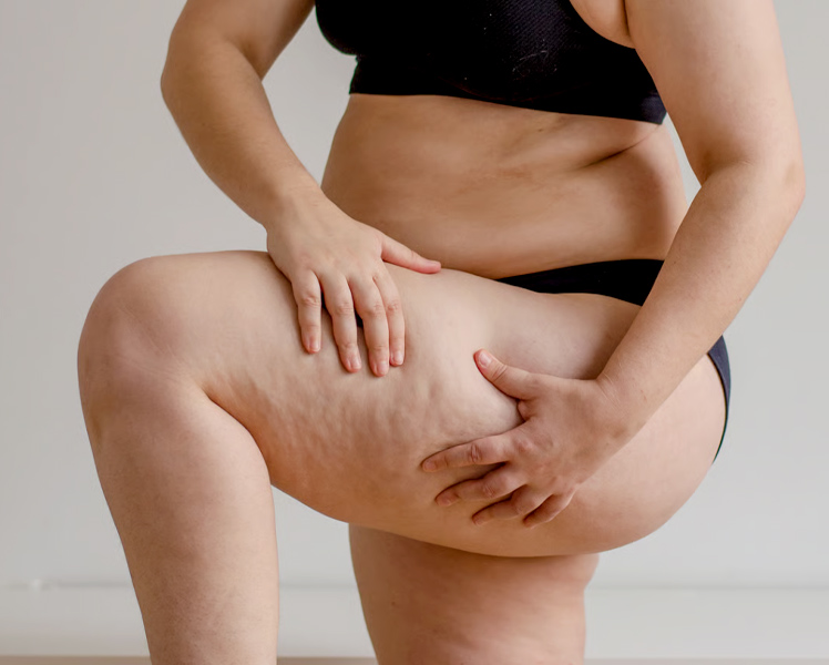 Frequently Asked Questions about Lipedema