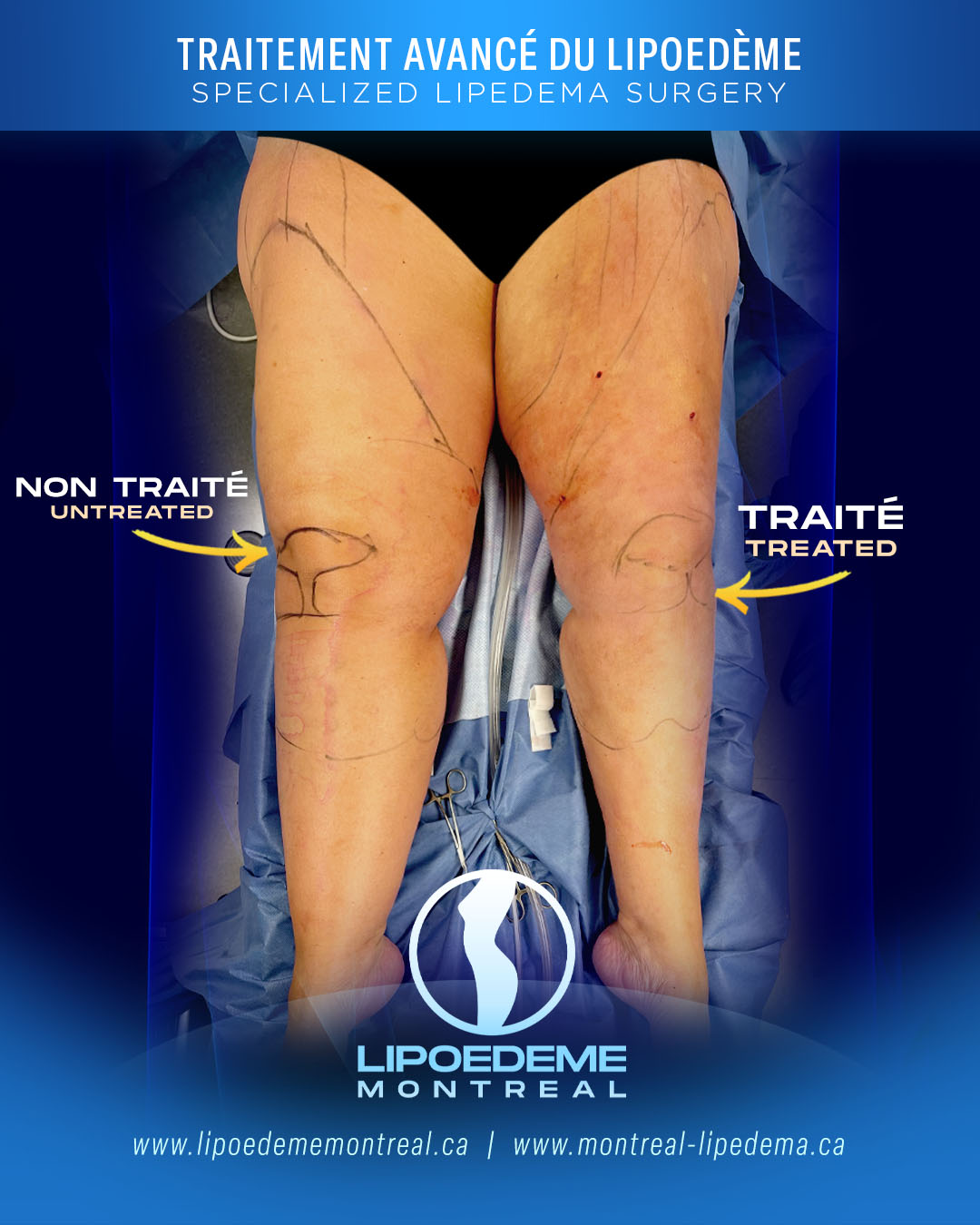 Before & After | Lipedema Treatment in Montreal