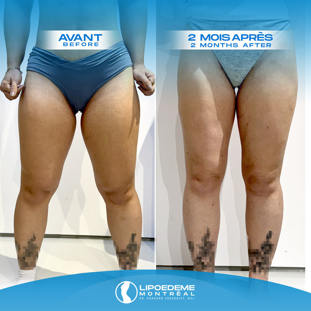 Lipedema Treatment in Montreal