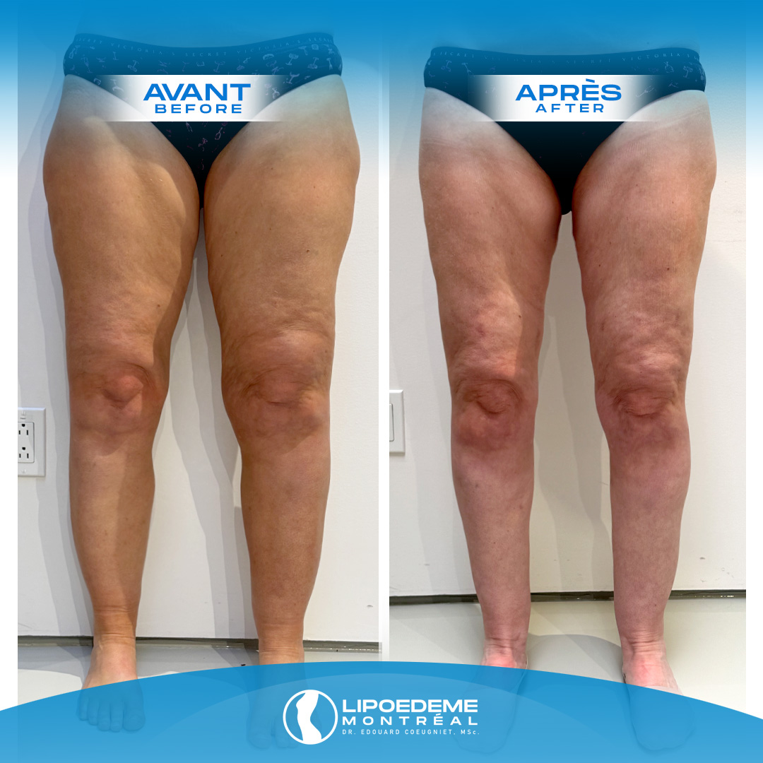 Lipedema Treatment in Montreal