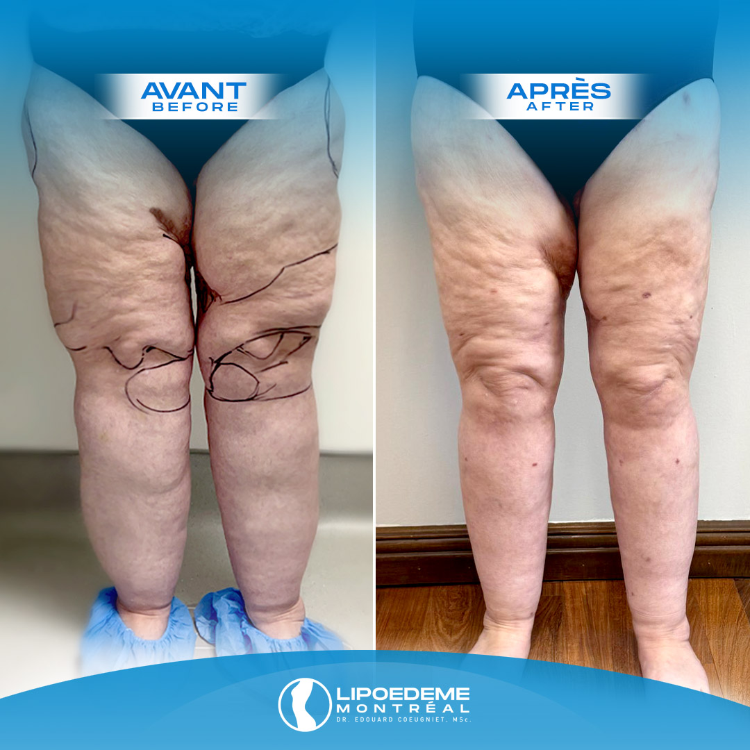 Lipedema Treatment in Montreal
