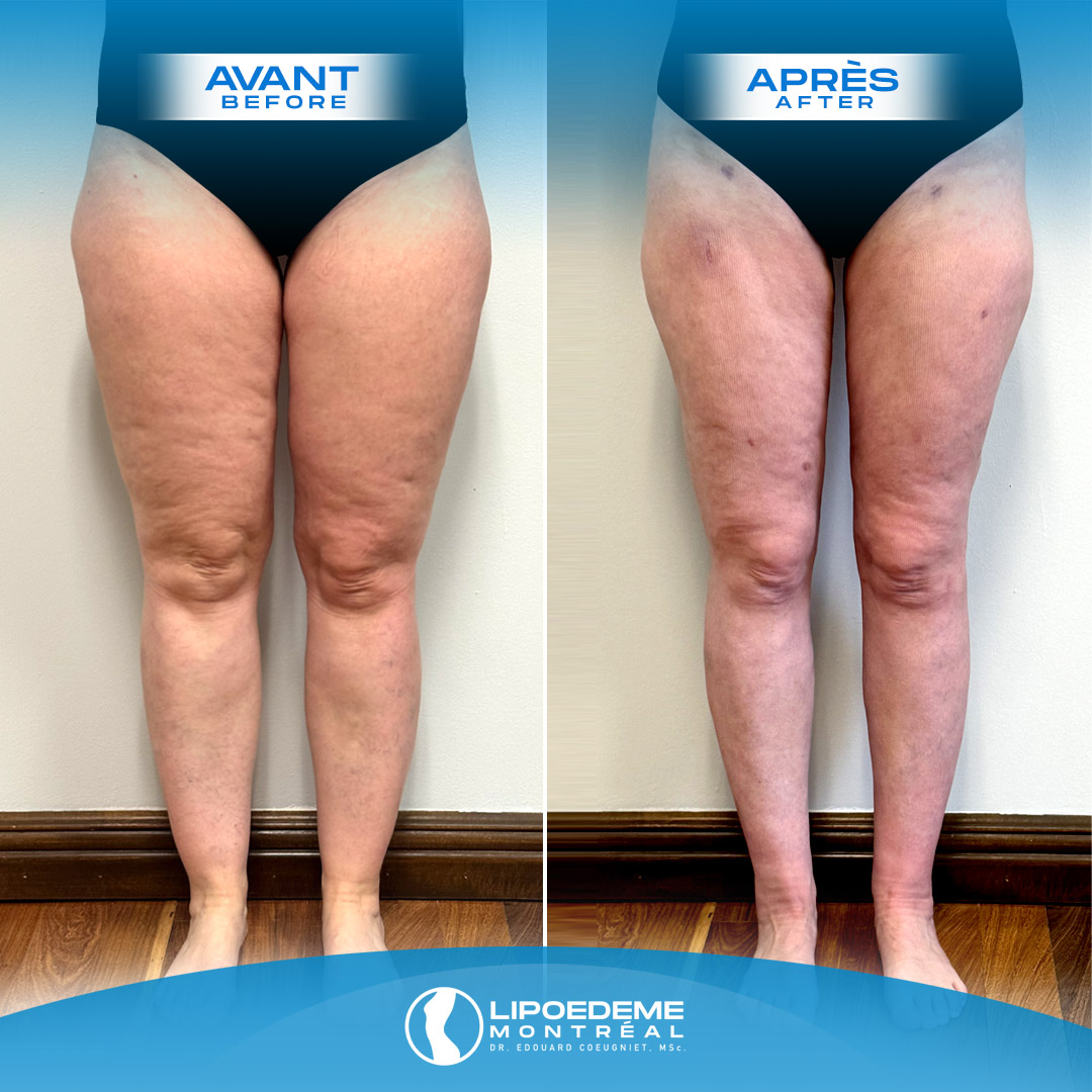 Lipedema Treatment in Montreal