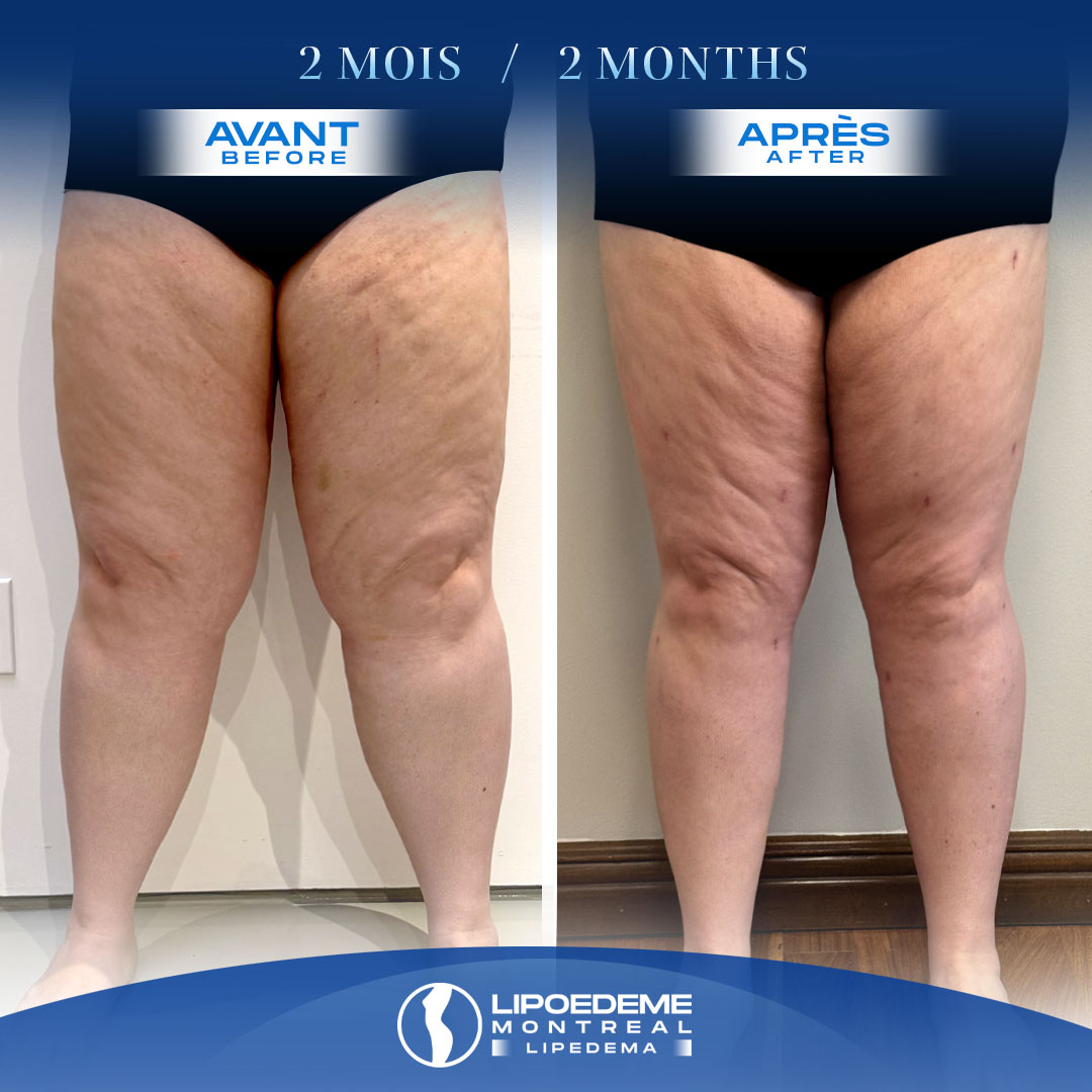 Lipedema Treatment in Montreal