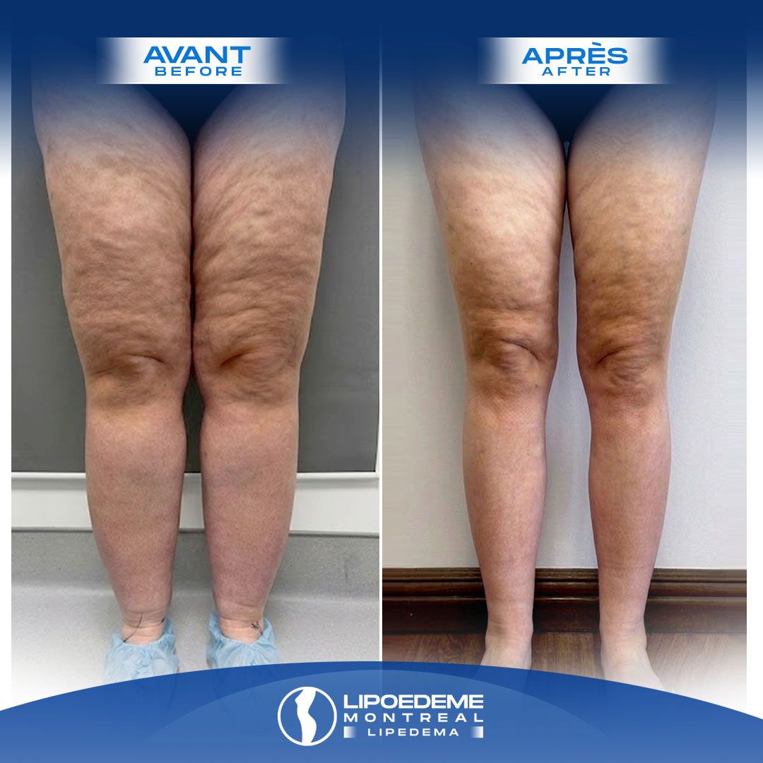 Before & After | Lipedema Reduction surgery in Montreal