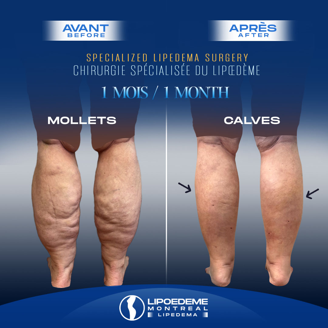 Before & After | Calves Lipedema Reduction surgery in Montreal