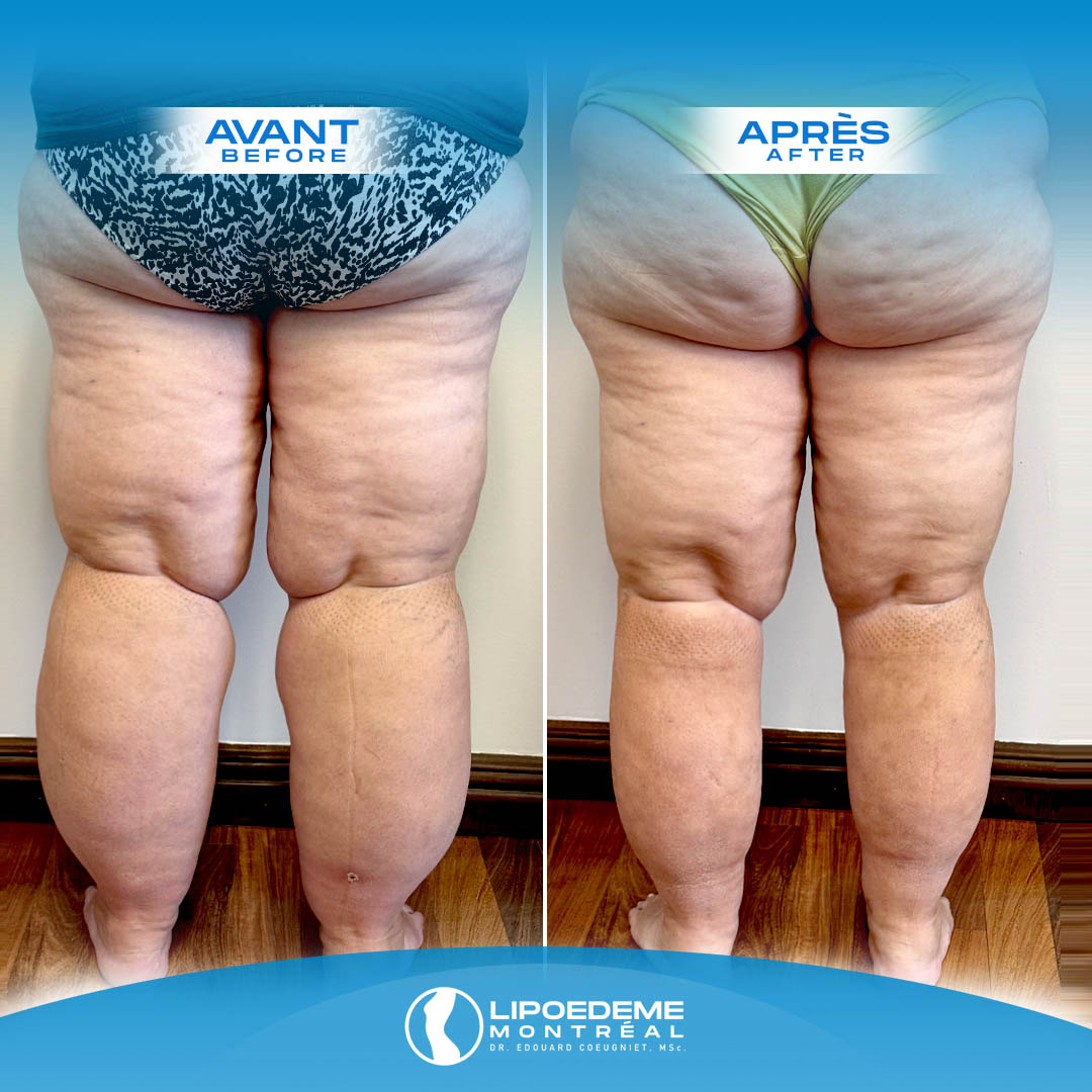 Lipedema Treatment in Montreal