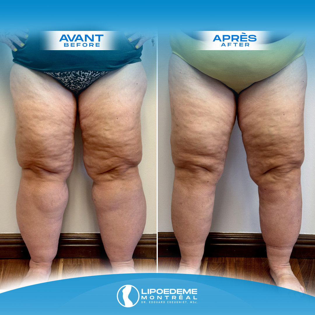 Lipedema Treatment in Montreal