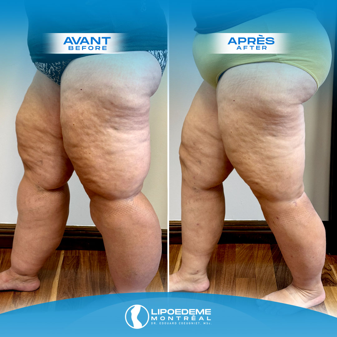 Lipedema Treatment in Montreal