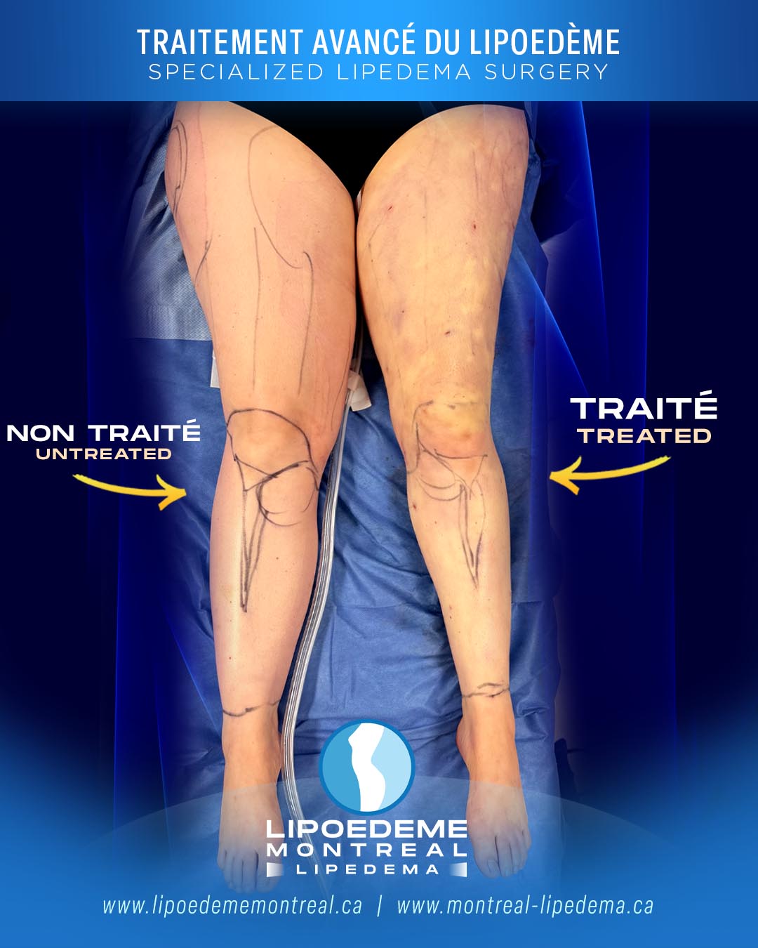 Before & After | Immediate Results | Lipedema Treatment in Montreal