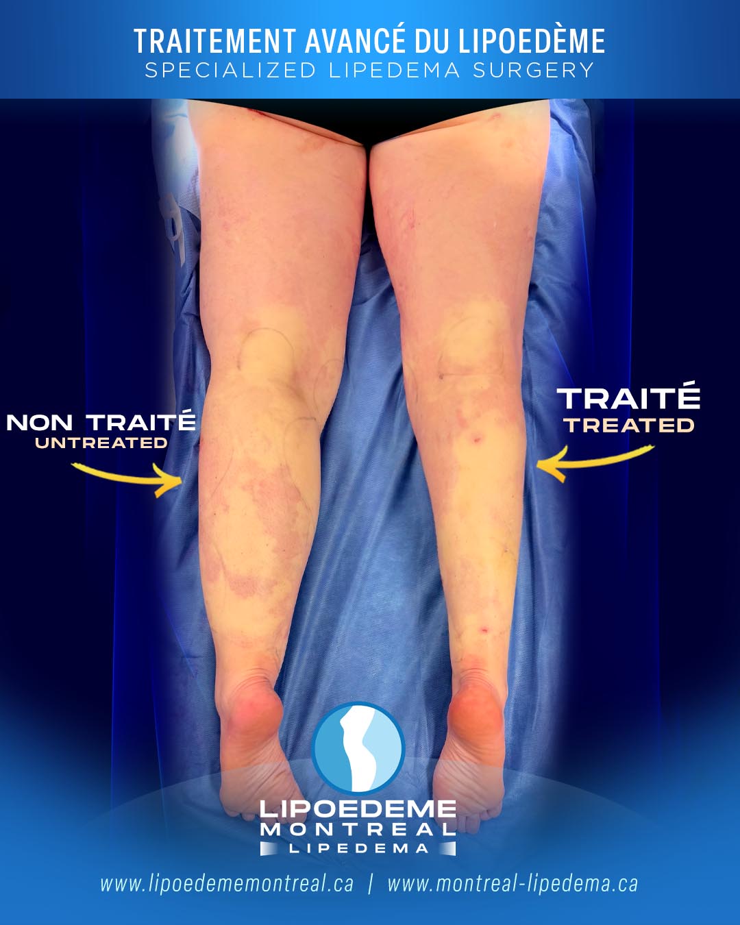 Before & After | Immediate Results | Lipedema Treatment in Montreal