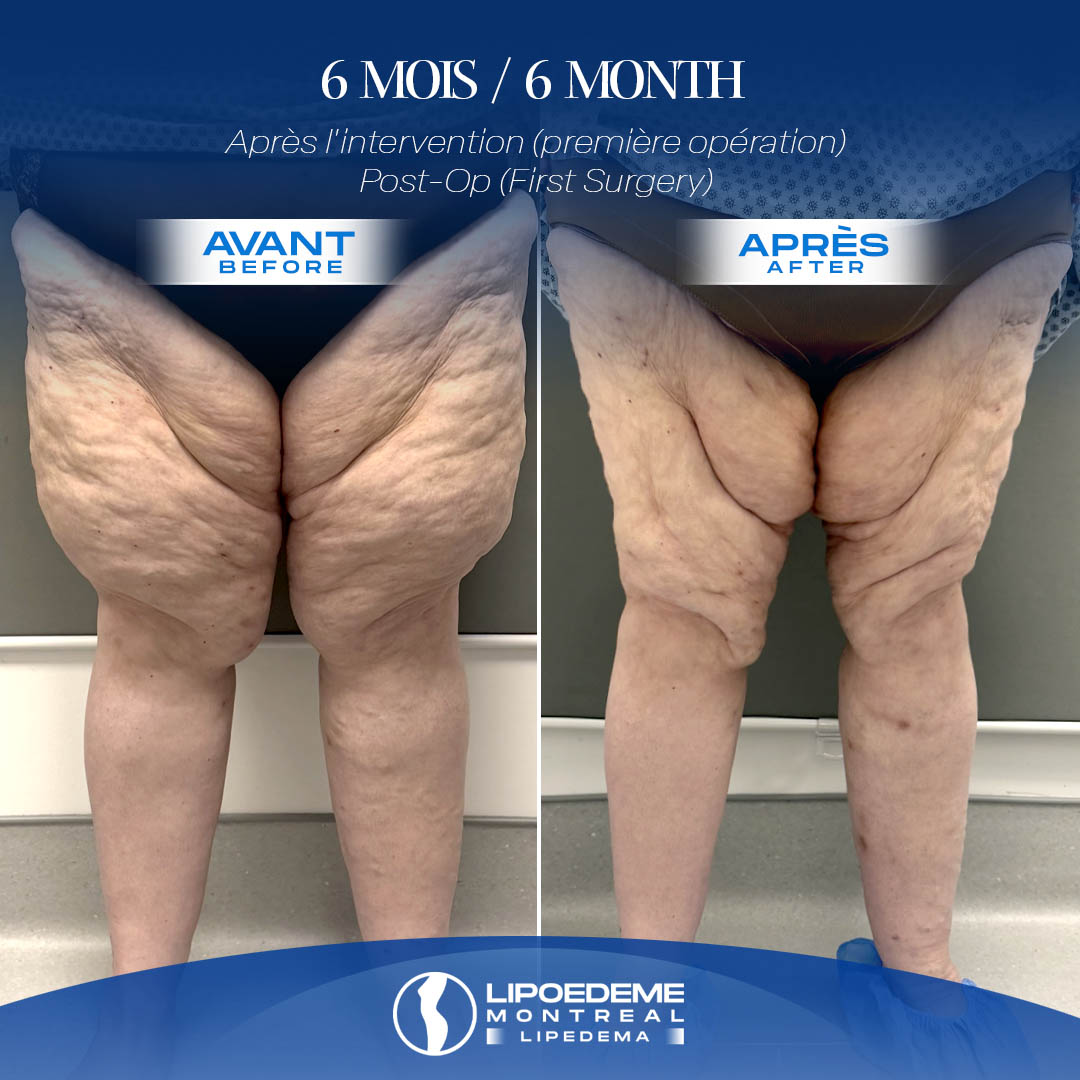 Before & After | Lipedema Reduction surgery in Montreal Canada