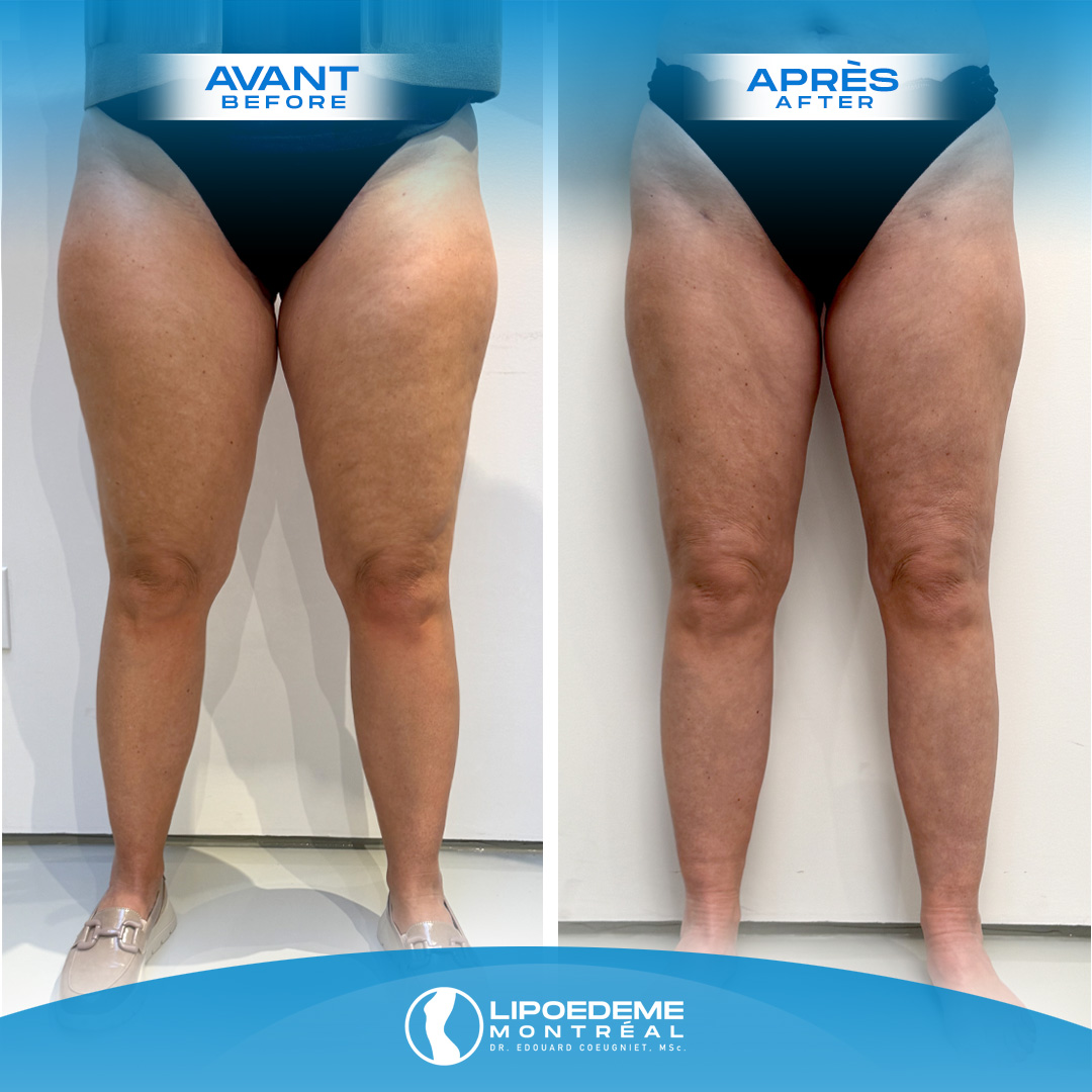 Lipedema Treatment in Montreal