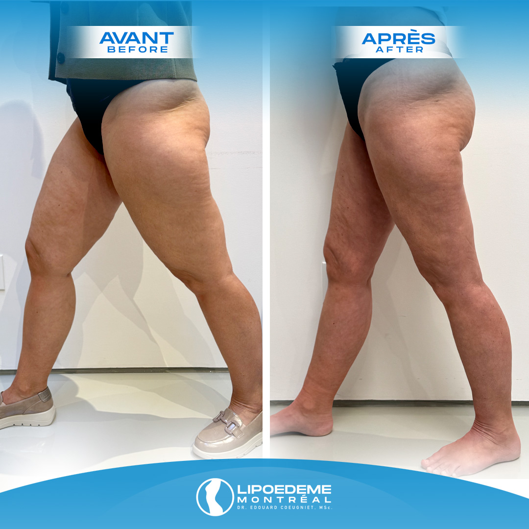 Before & After | Lipedema Treatment in Montreal
