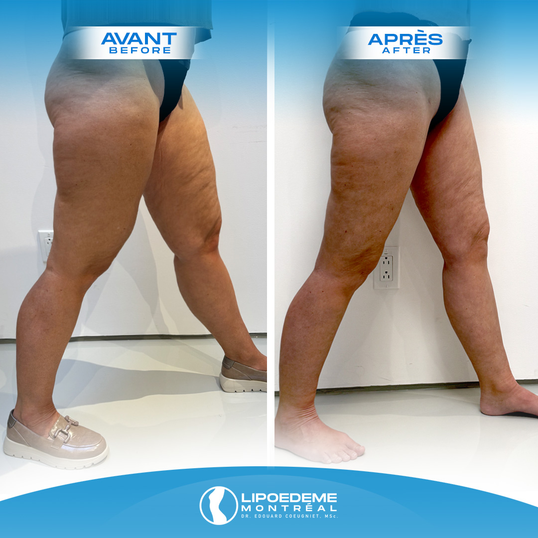 Before & After | Lipedema Treatment in Montreal