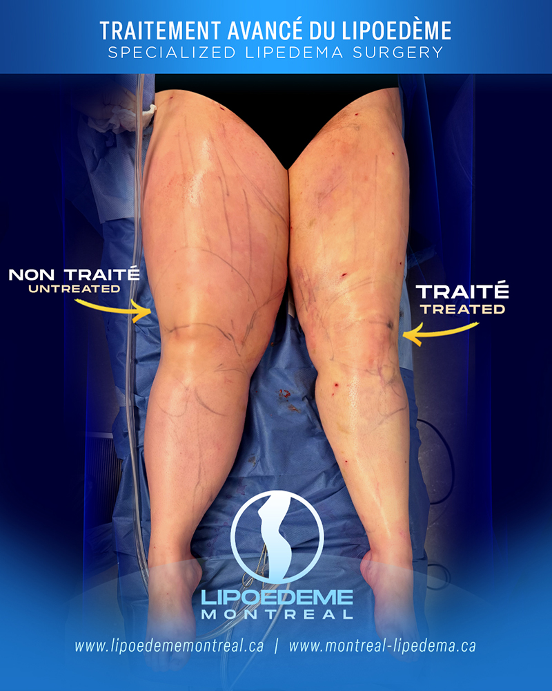 Before & After | Immediate Results |  Lipedema Treatment in Montreal