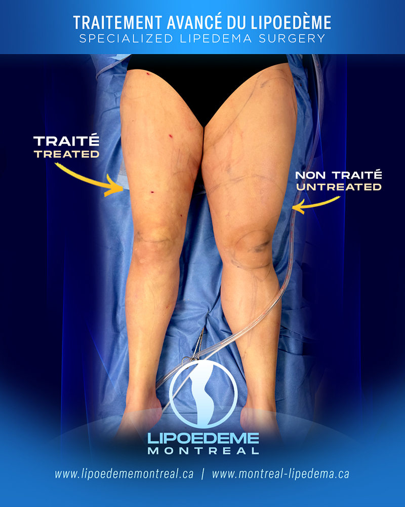 Before & After | Immediate Results |  Lipedema Treatment in Montreal