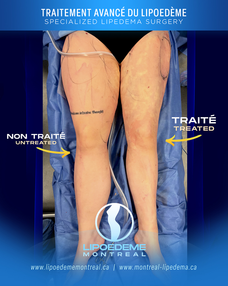Before & After | Immediate Results | Lipedema Treatment in Montreal