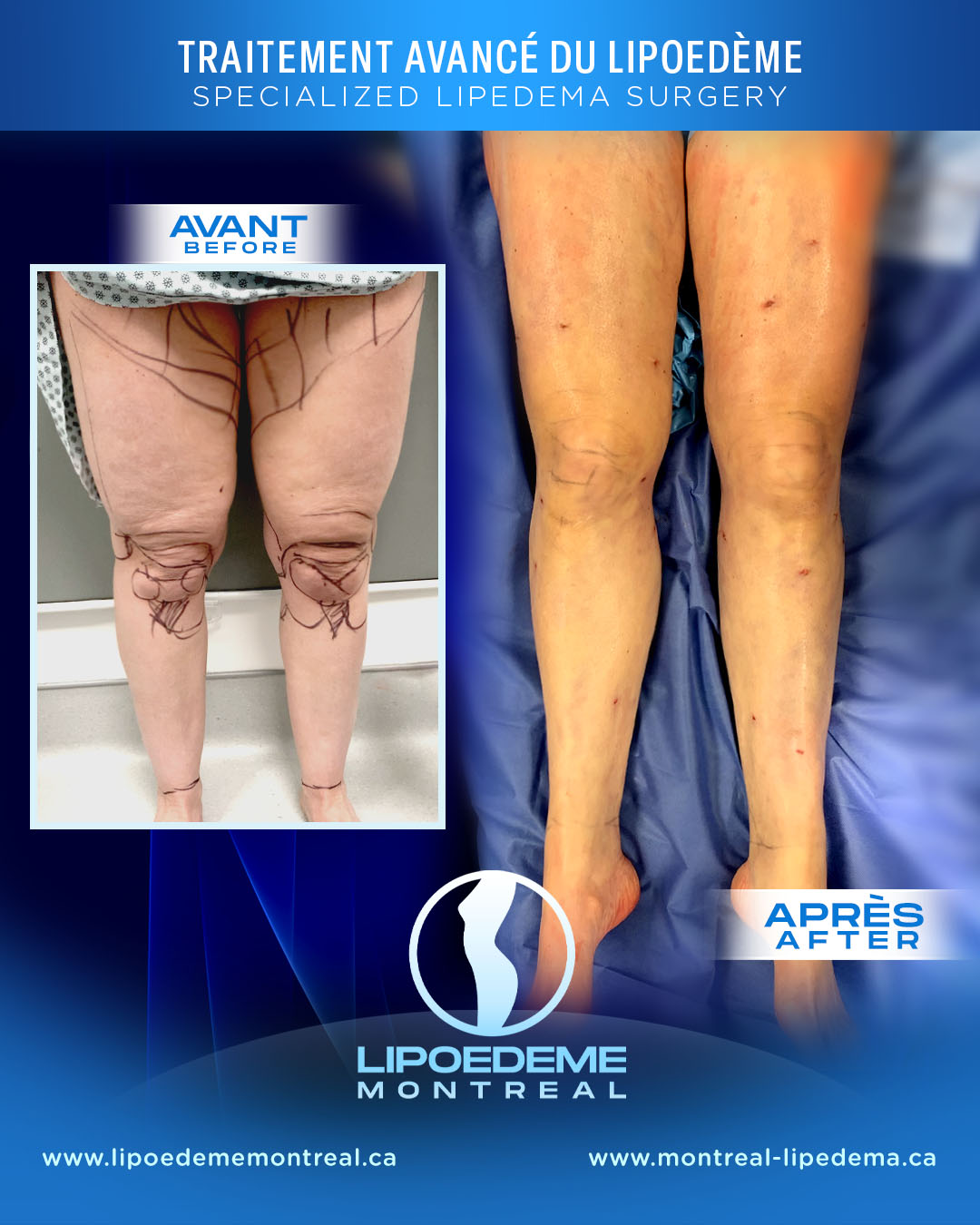 Before & After | Lipedema Treatment in Montreal