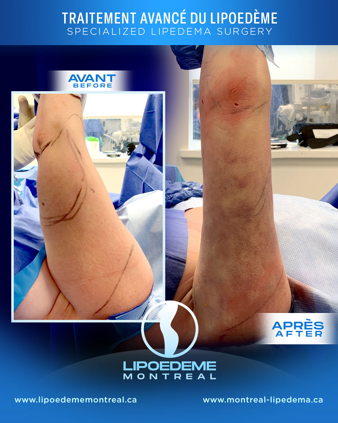 Before & After | Lipedema Treatment in Montreal