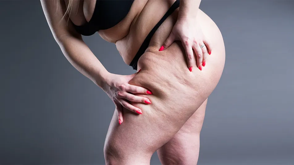 Sign and Symptoms of Lipedema