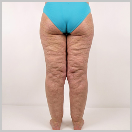 Legs - Back