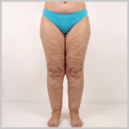 Legs - Front