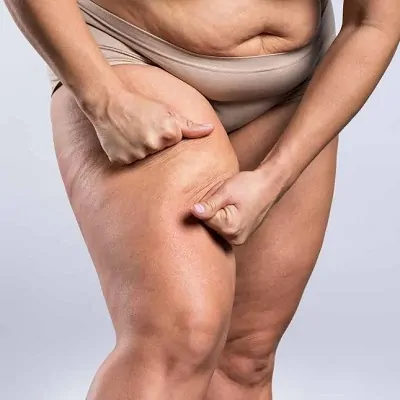 Treatment for lipoedema in Montreal - Quebec - Canada