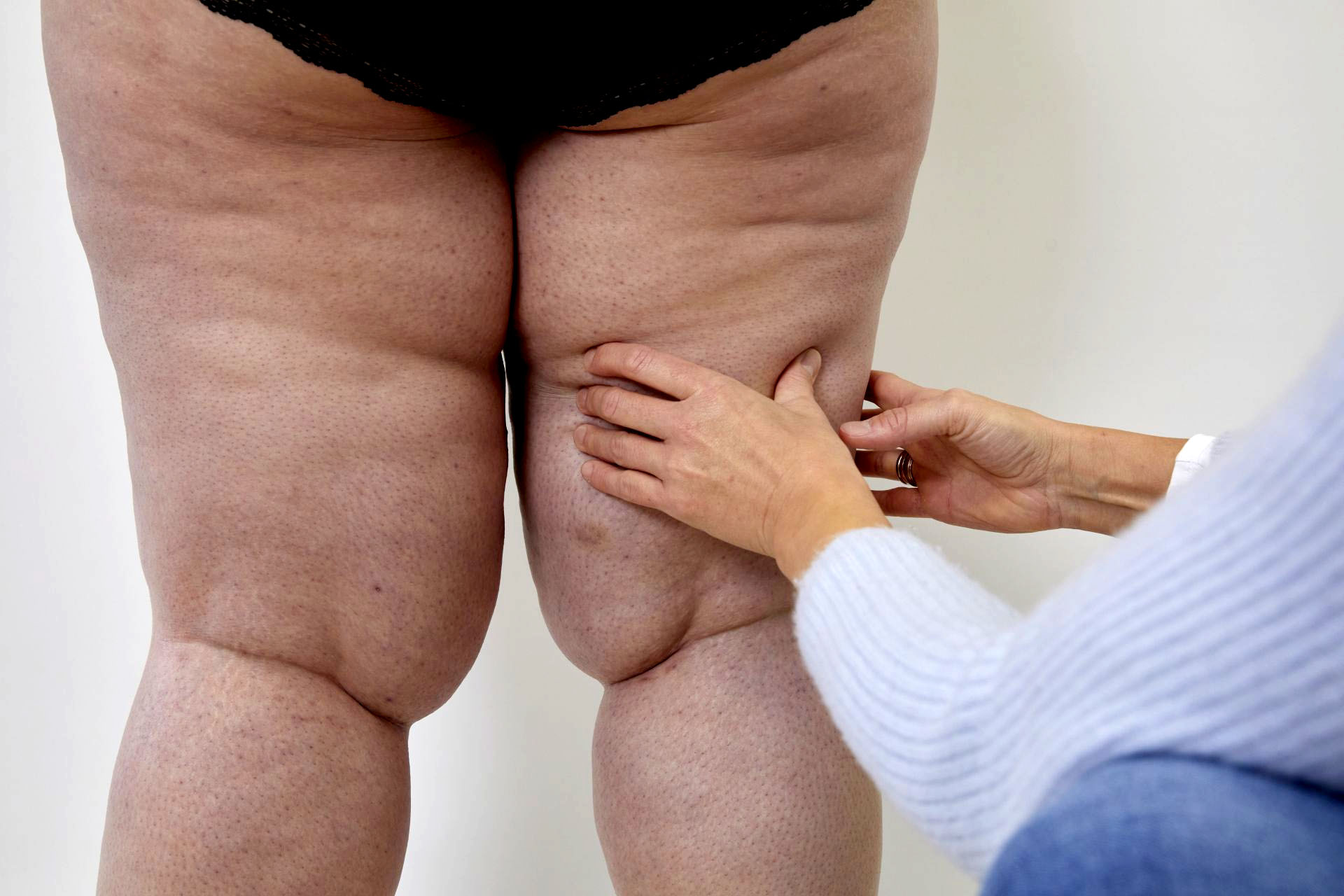What are Lipedema Symptoms? Montreal - Quebec - Canada